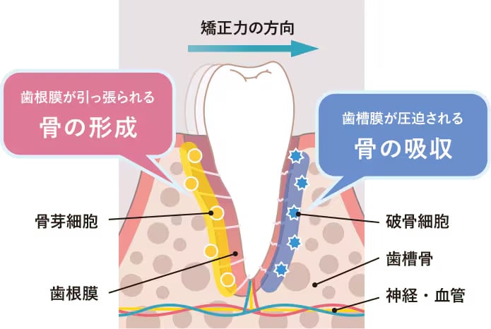 Vproで矯正期間が短縮できる原理