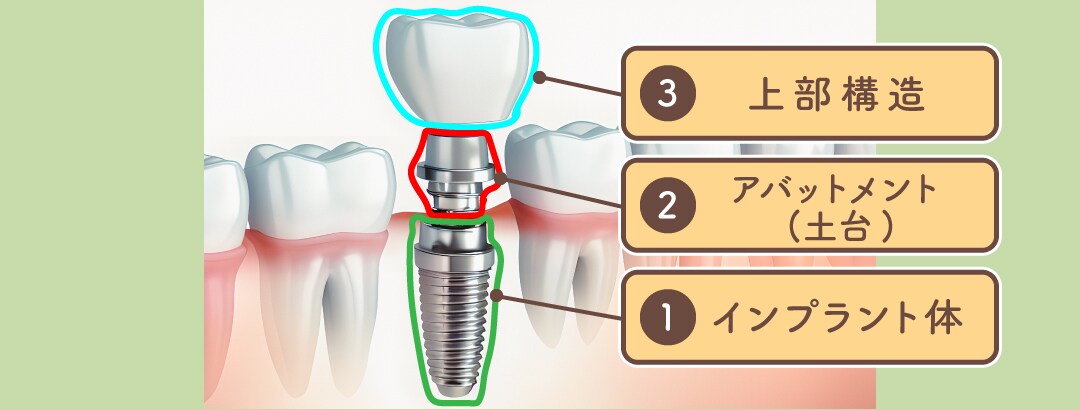 インプラントは基本的に3つのパーツからできています。