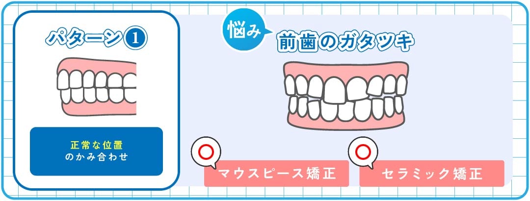 パターン①｜歯のガタツキ