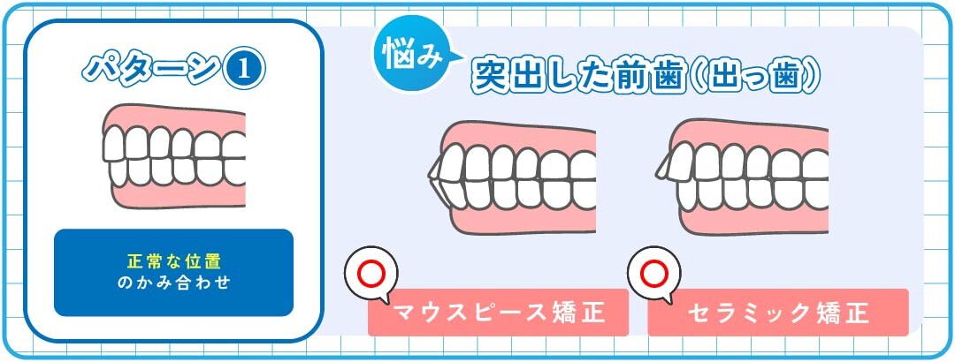 パターン①｜突出した前歯（出っ歯）