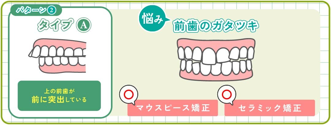 パターン②-A｜歯のガタツキ