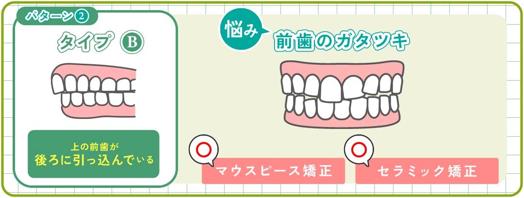 パターン②-B｜前歯のガタツキ