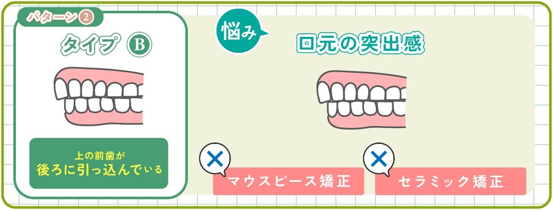 パターン②-B｜前歯（口元）の突出感