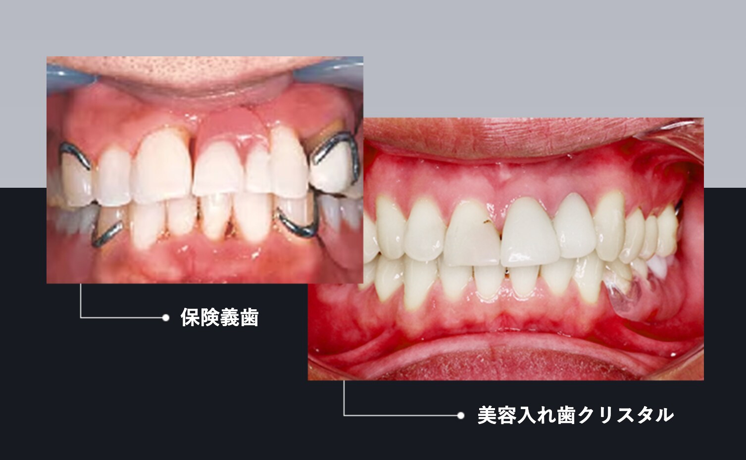 目立たない入れ歯、脱！入れ歯感！美容入れ歯