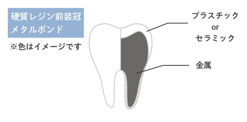 硬質レジン前装冠 / メタルボンド