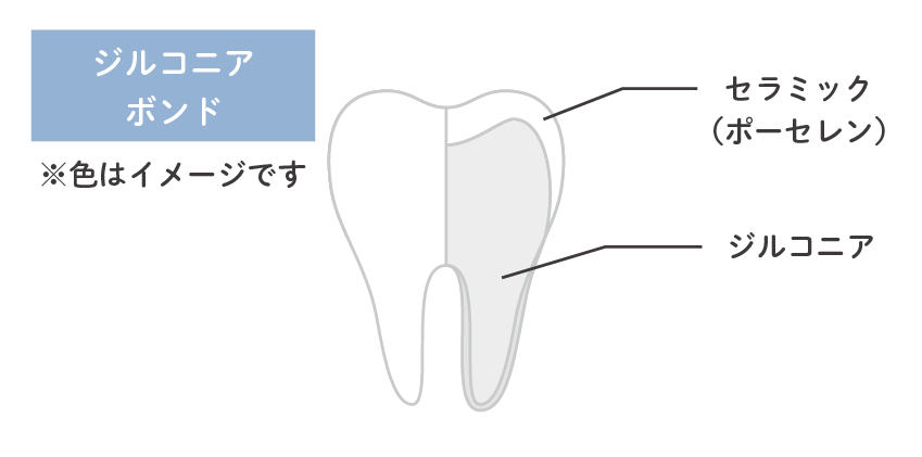 ジルコニアボンド