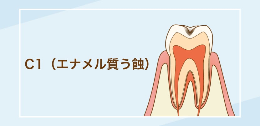 C1（エナメル質う蝕）