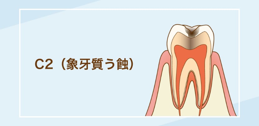 C2（象牙質う蝕）