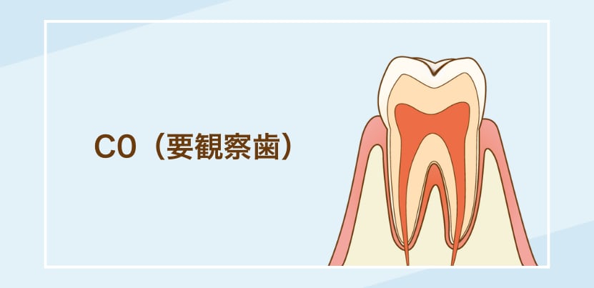 C0（要観察歯）