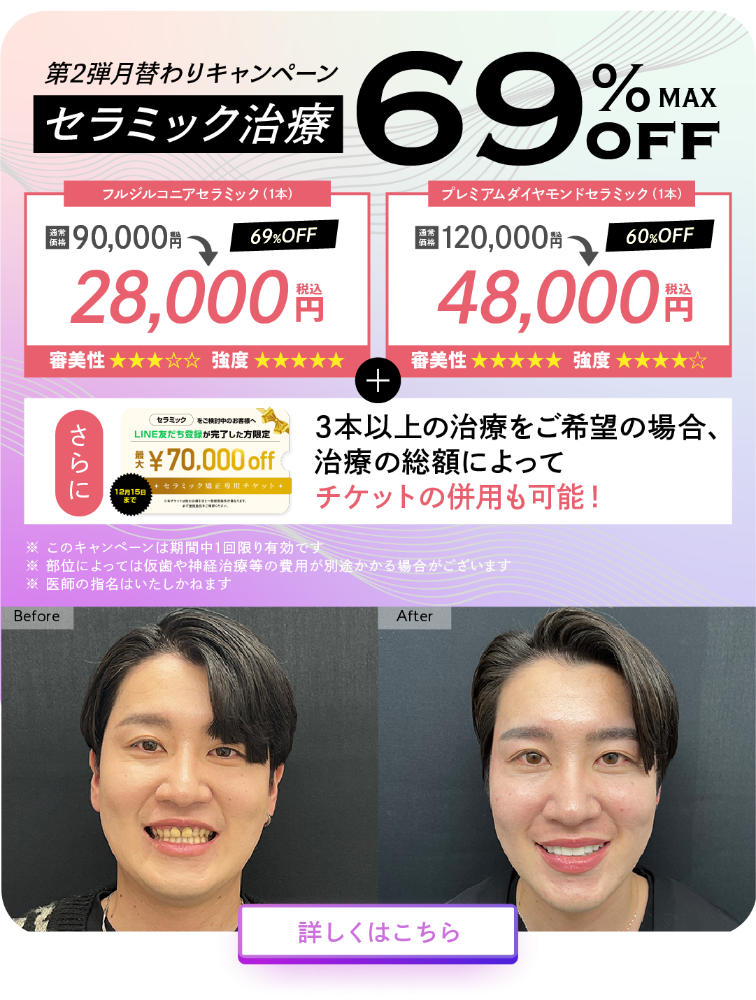 セラミック矯正が最大69%OFF！