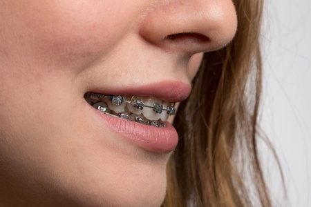 専門医が解説 悪い歯並びを治したいなら歯列矯正 矯正器具の種類や治療期間 費用 ハコラム