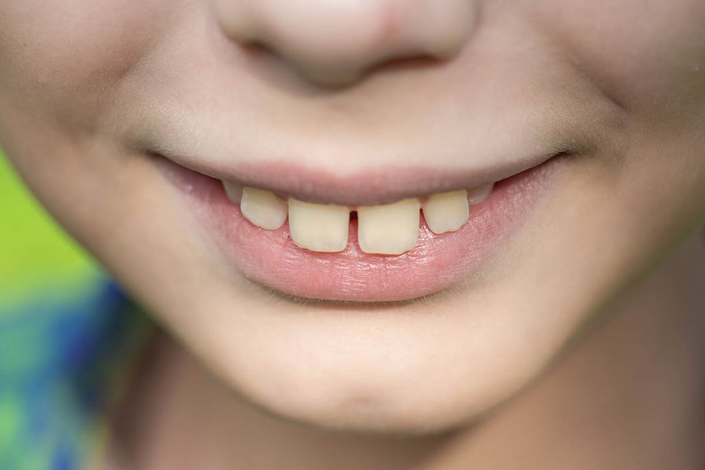 専門医が解説 出っ歯は整形 矯正で治療が可能 受け口など口元の印象も変えられる ハコラム
